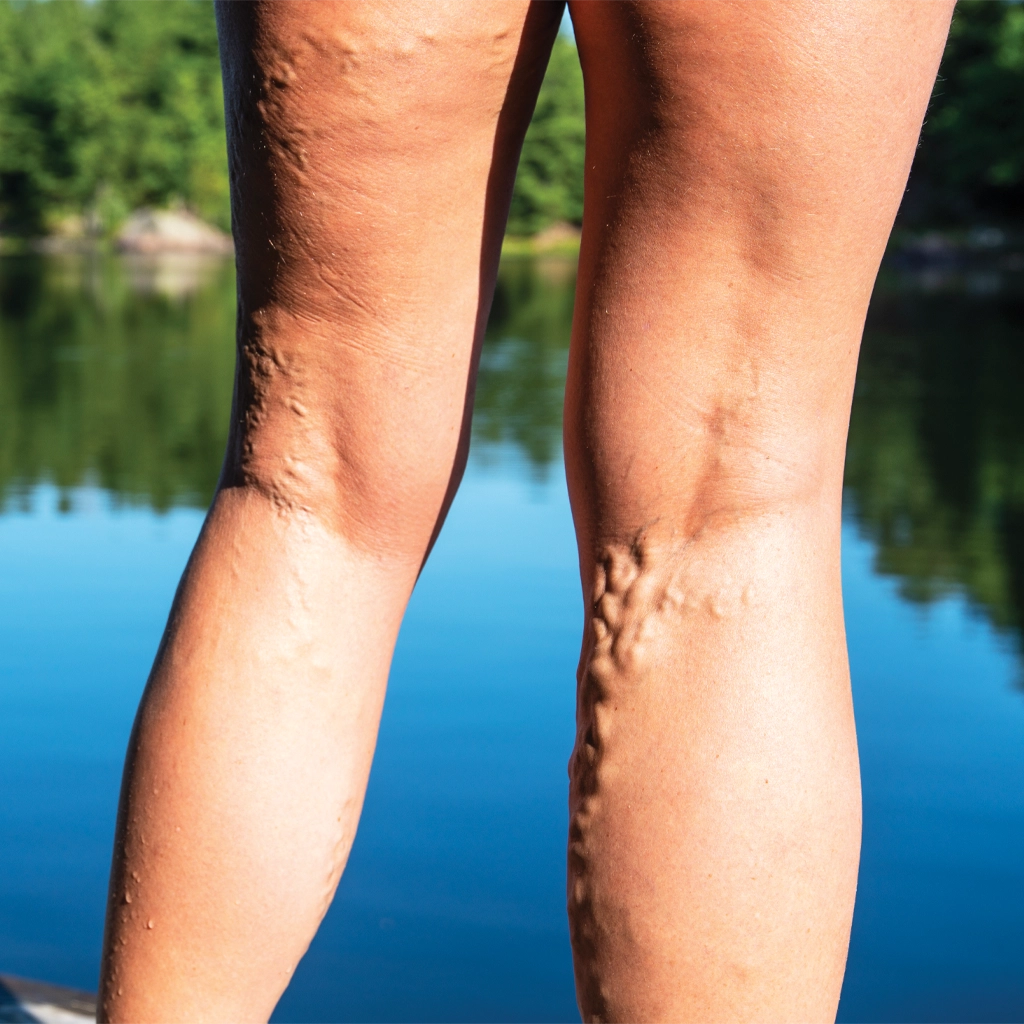 varicose veins
