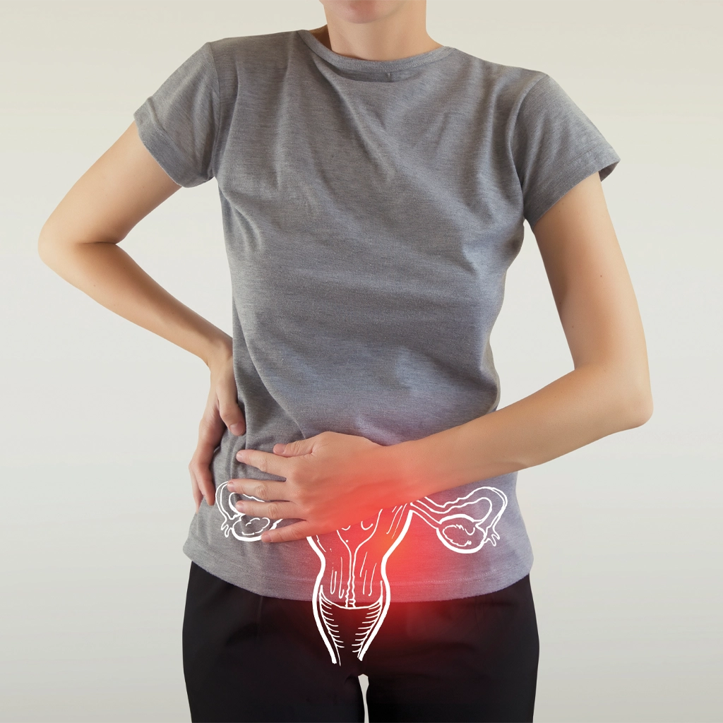 Pelvic Congestion Syndrome (PCS)