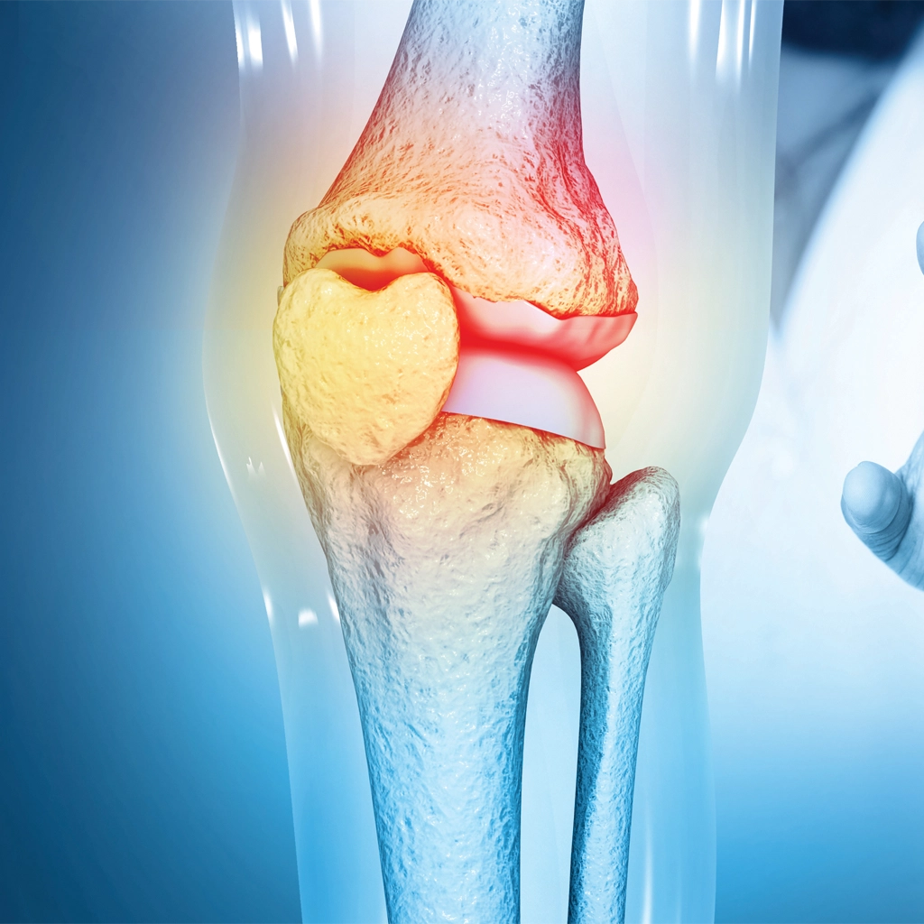 Genicular Artery Embolization
