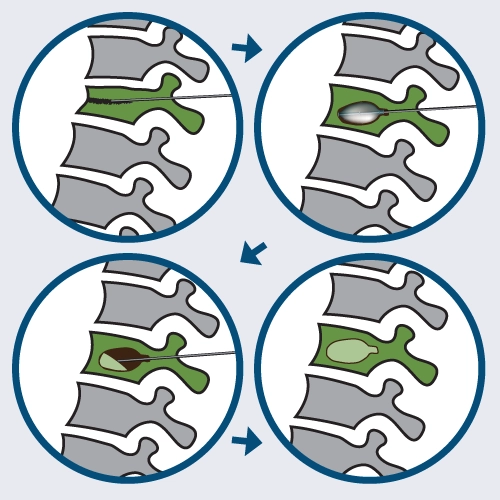 vertebral augmentation