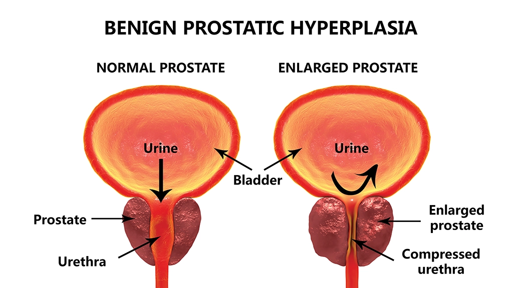 normal vs enlarged prostate