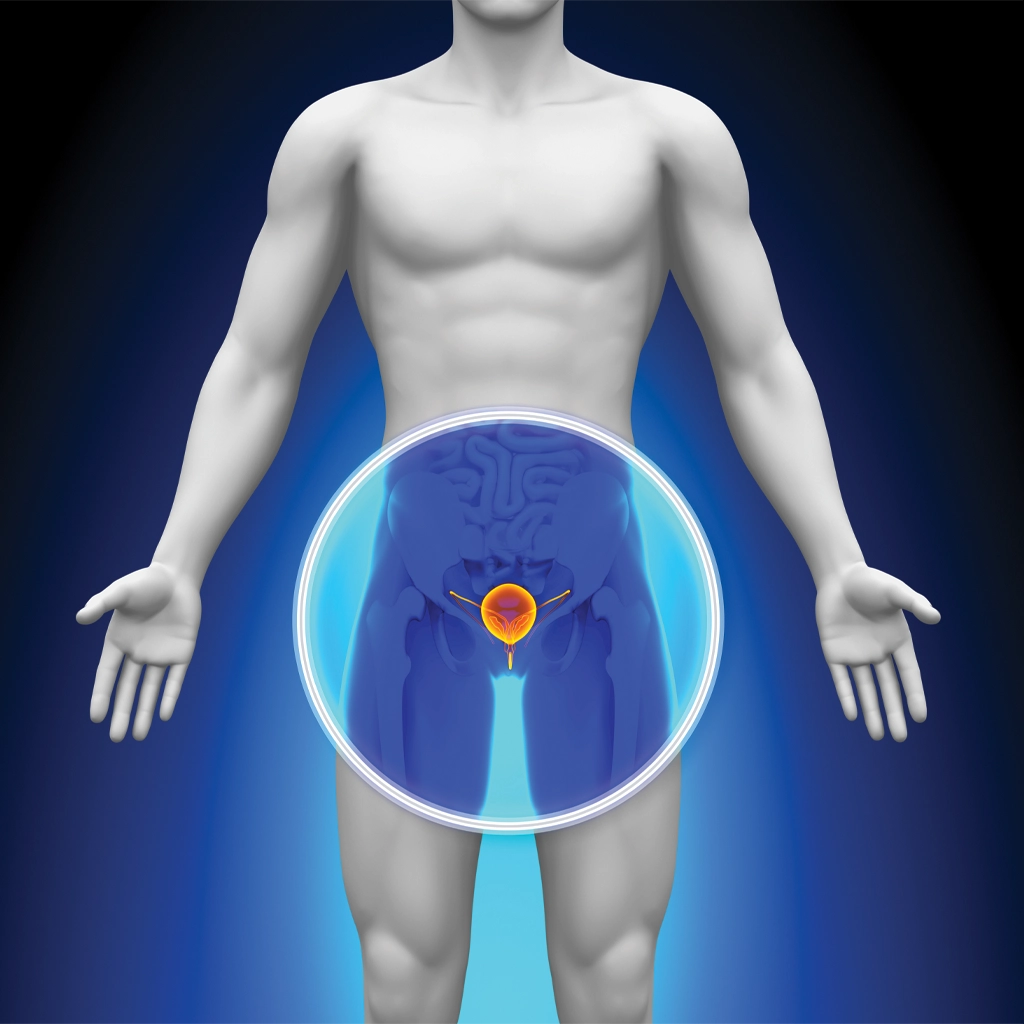 Benign Prostatic Hyperplasia (BPH)