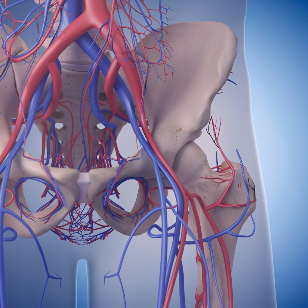 May-Thurner Syndrome