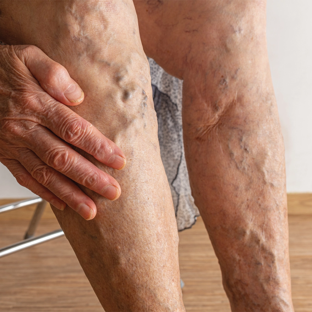 varicose veins treatment