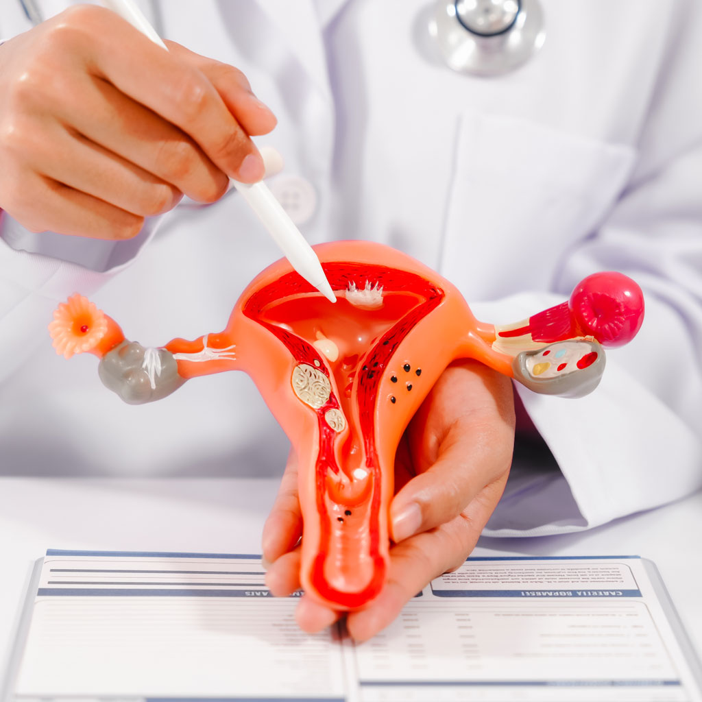 Uterus Model for Uterine Fibroid Embolization vs. Hysterectomy