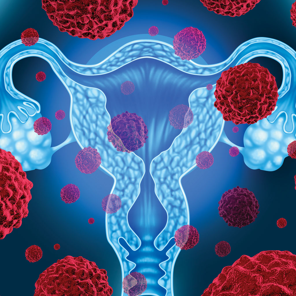 Uterine Fibroid Embolization or Myomectomy Illustration