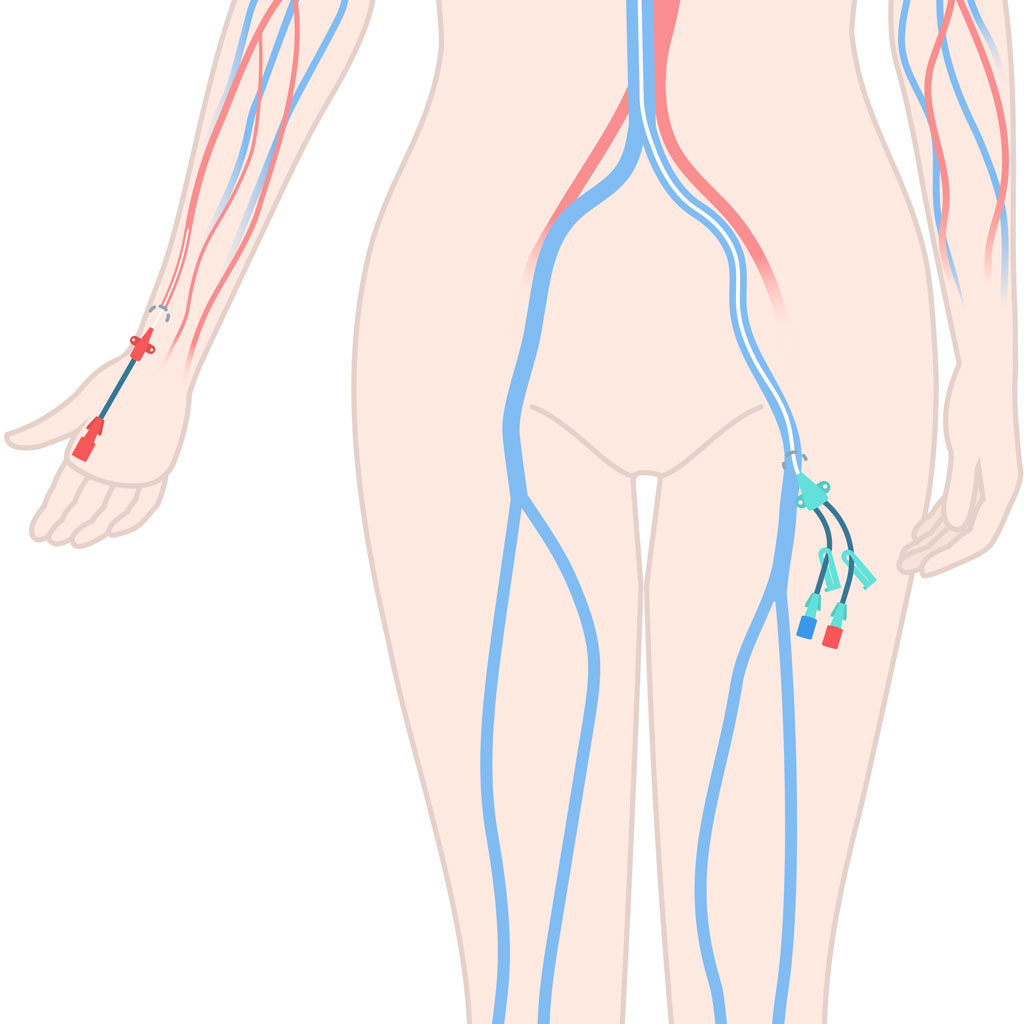 Wrist vs. Groin Access for Embolization Illustration