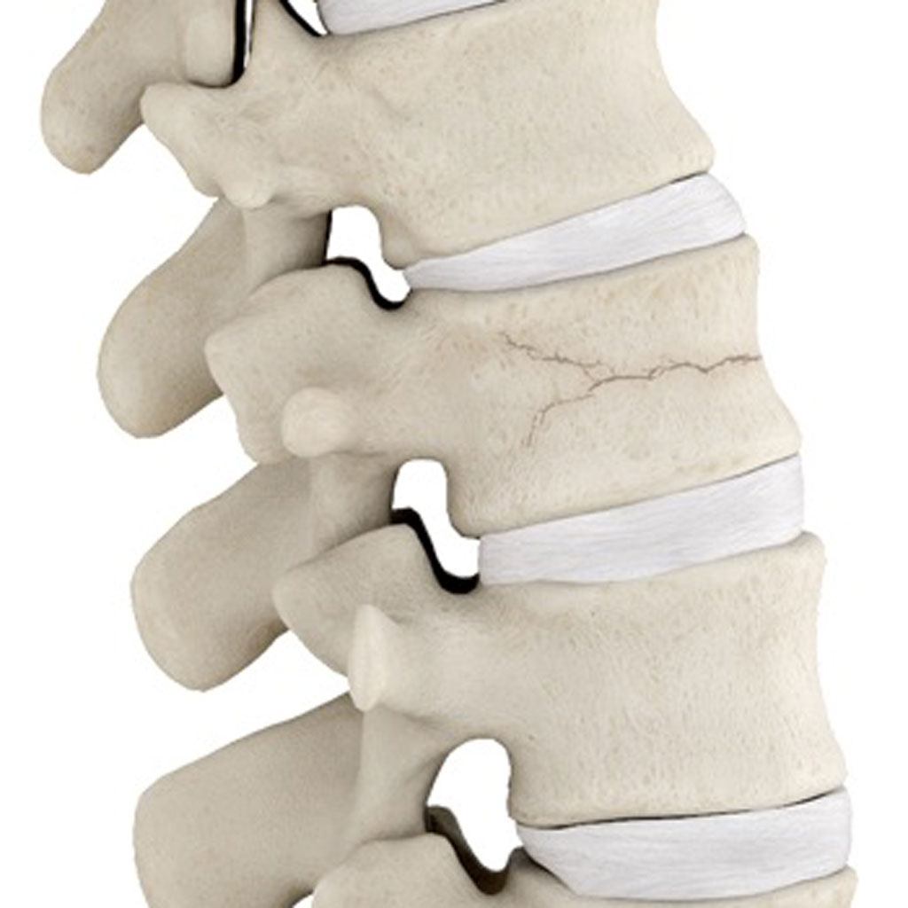 Vertebral Compression Fractures