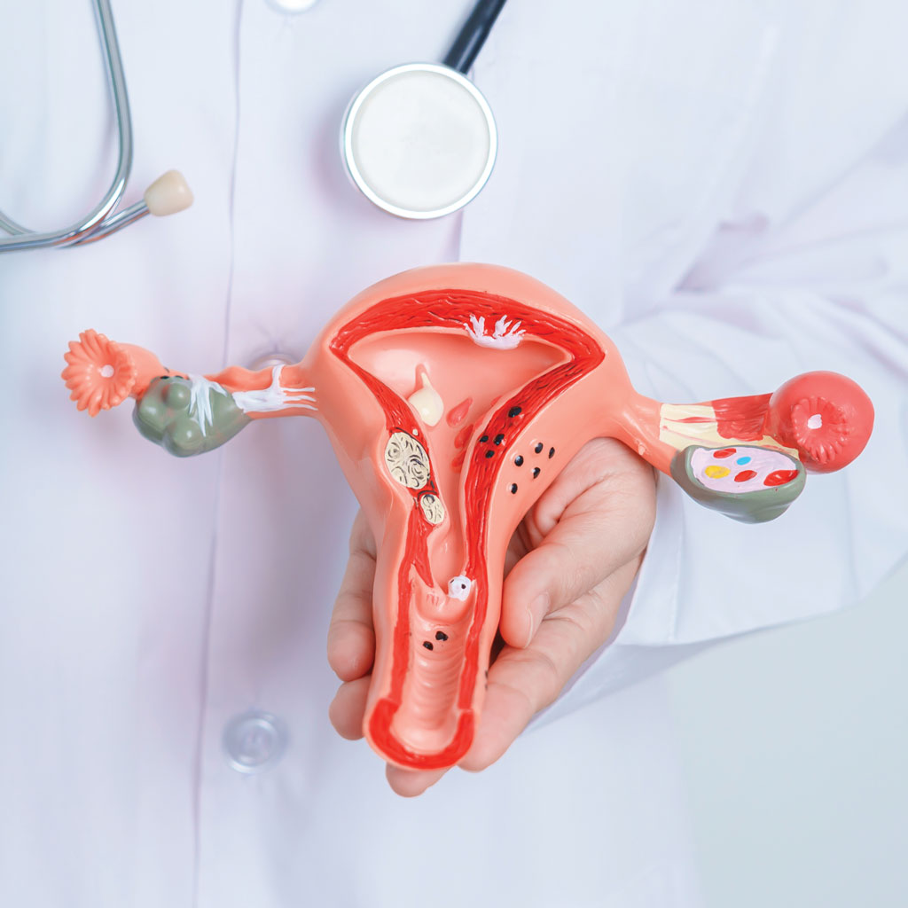 Uterine Artery Embolization vs. Hysterectomy Uterus Model