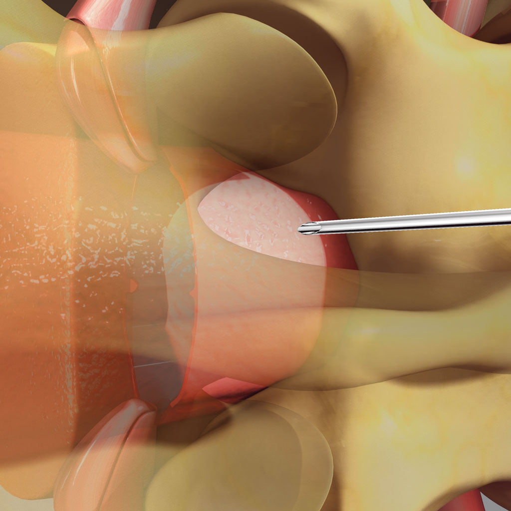 Superior Hypogastric Nerve Block Illustration