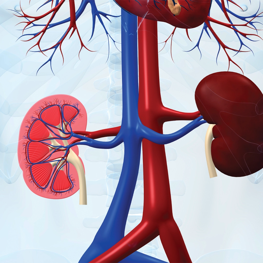 Renal Angiomyolipoma (AML) Embolization