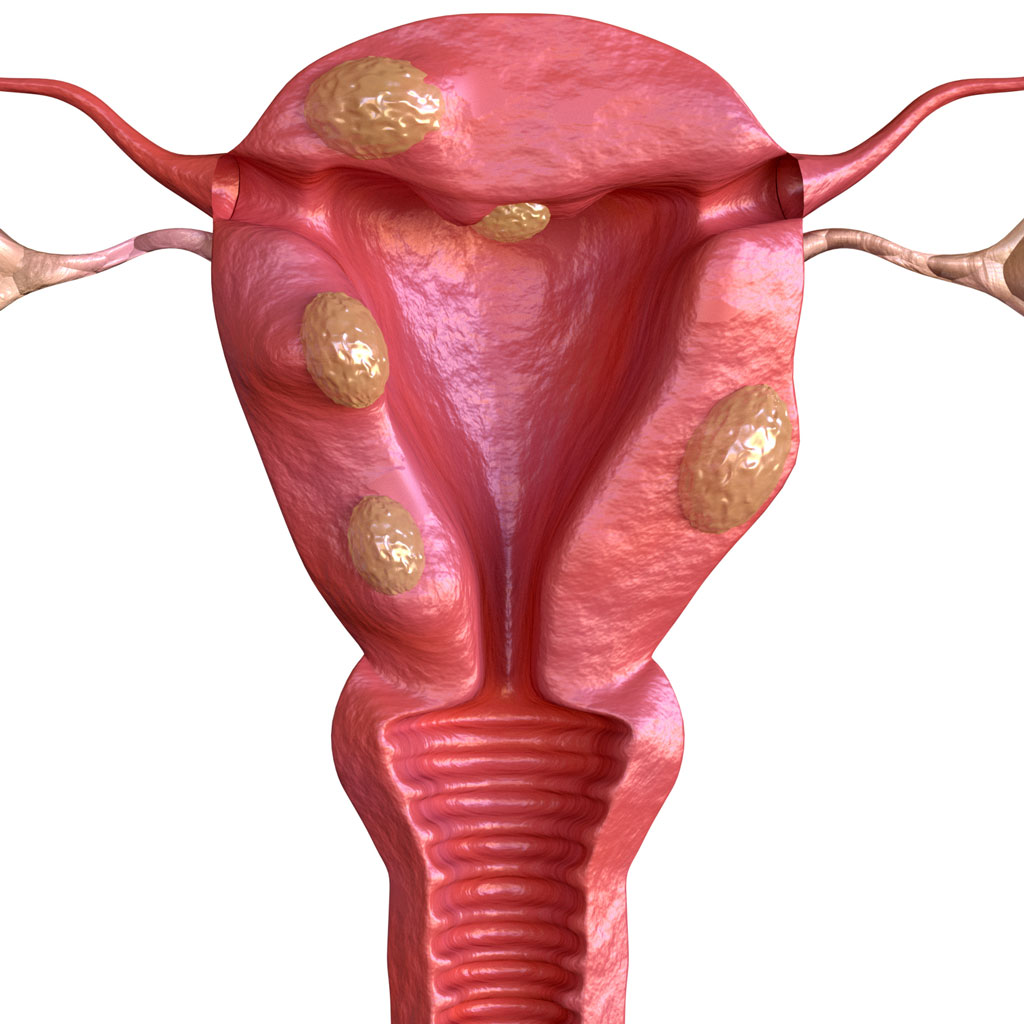 Uterus render with fibroids to help explain what is UFE