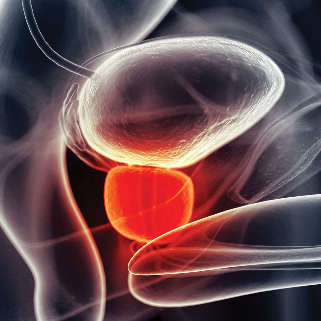 Enlarged Prostate Illustration