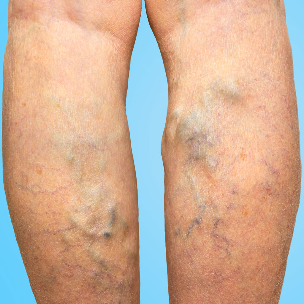 Legs That Need Treatments for Varicose Veins