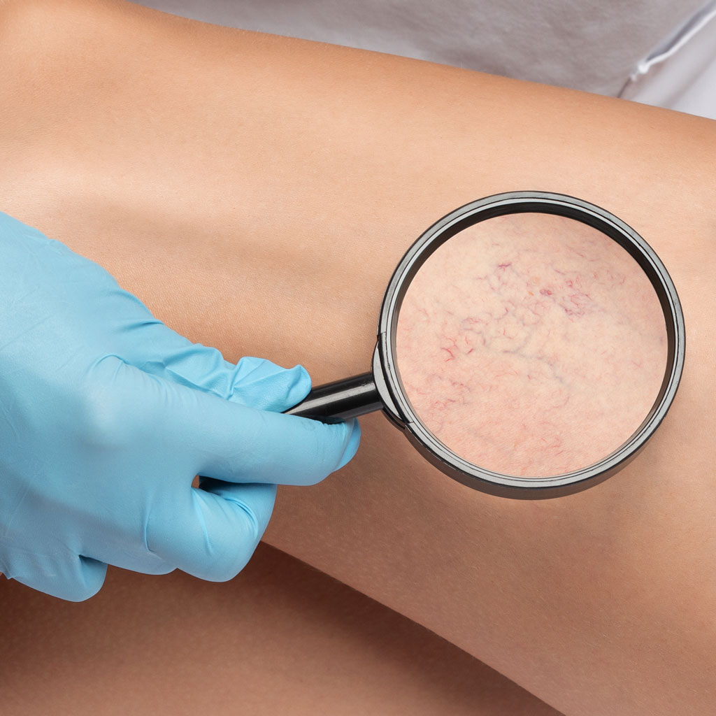 Varicose Veins vs. Spider Veins Magnifying Glass