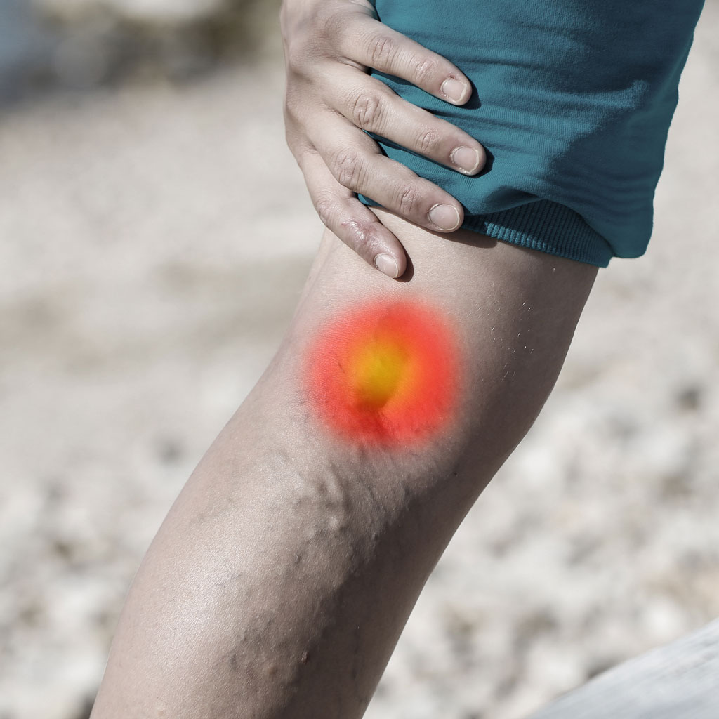 See a doctor about varicose veins pain